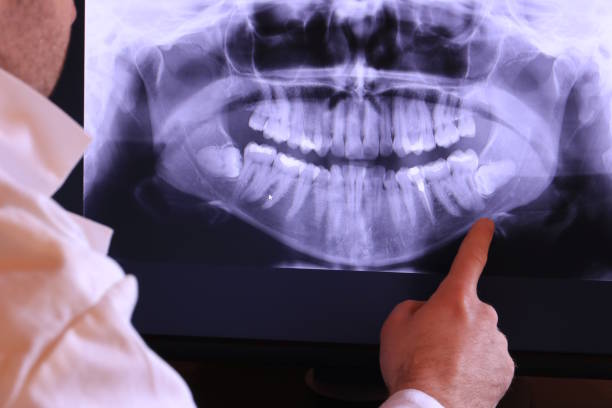Best Emergency Wisdom Tooth Extraction in Haliimaile, HI